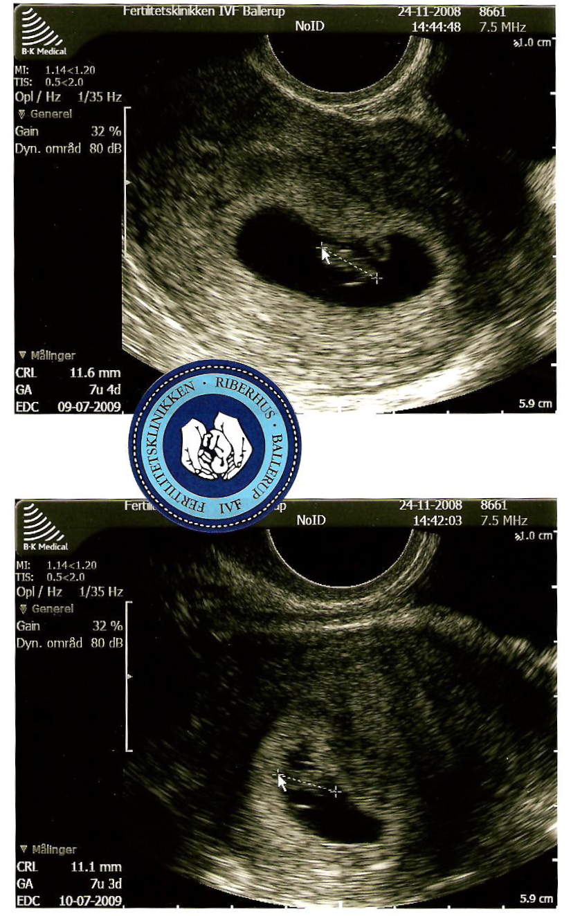 billede2 Første billede af vores lille baby